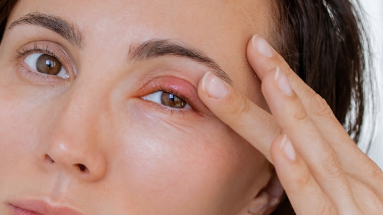 Göz kapaklarınızda sürekli kızarıklık varsa sebebi blefarit olabilir