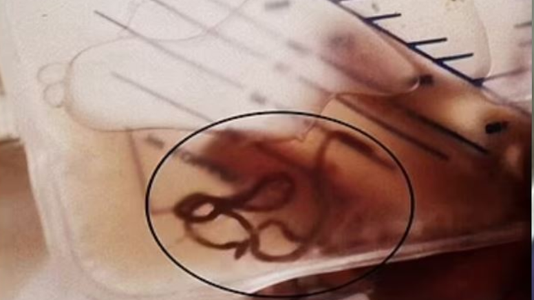 Çiğ çiğ yediği o besin yüzünden idrarından solucan çıktı: Bu hatayı yapmayın!