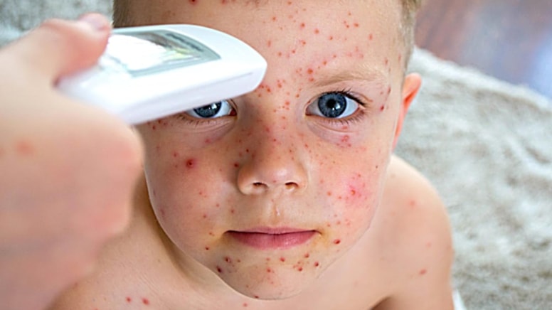 Aşılanmamış her 10 çocuktan 9'u kızamık oluyor