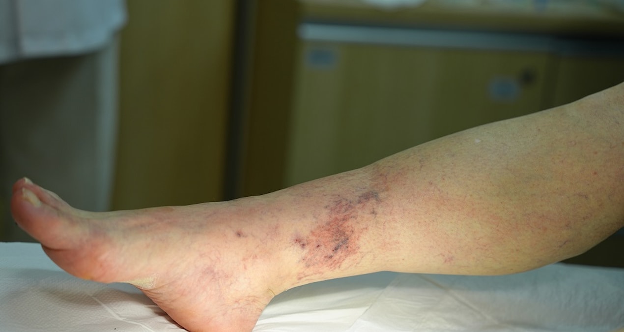 Göz Ardı Etmeyin! Varis Tedavisi Olmazsa Ne Olur? Uzman Diyor Ki...