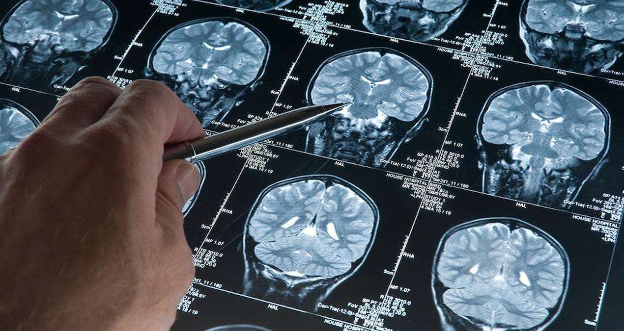 626303alzheimerarastirmalarindariskiartiran226839media1jpg-QKUvwk7tB02WSEQ6rM6Ncg Alzheimer riskini artıran yeni genetik varyant tespit edildi