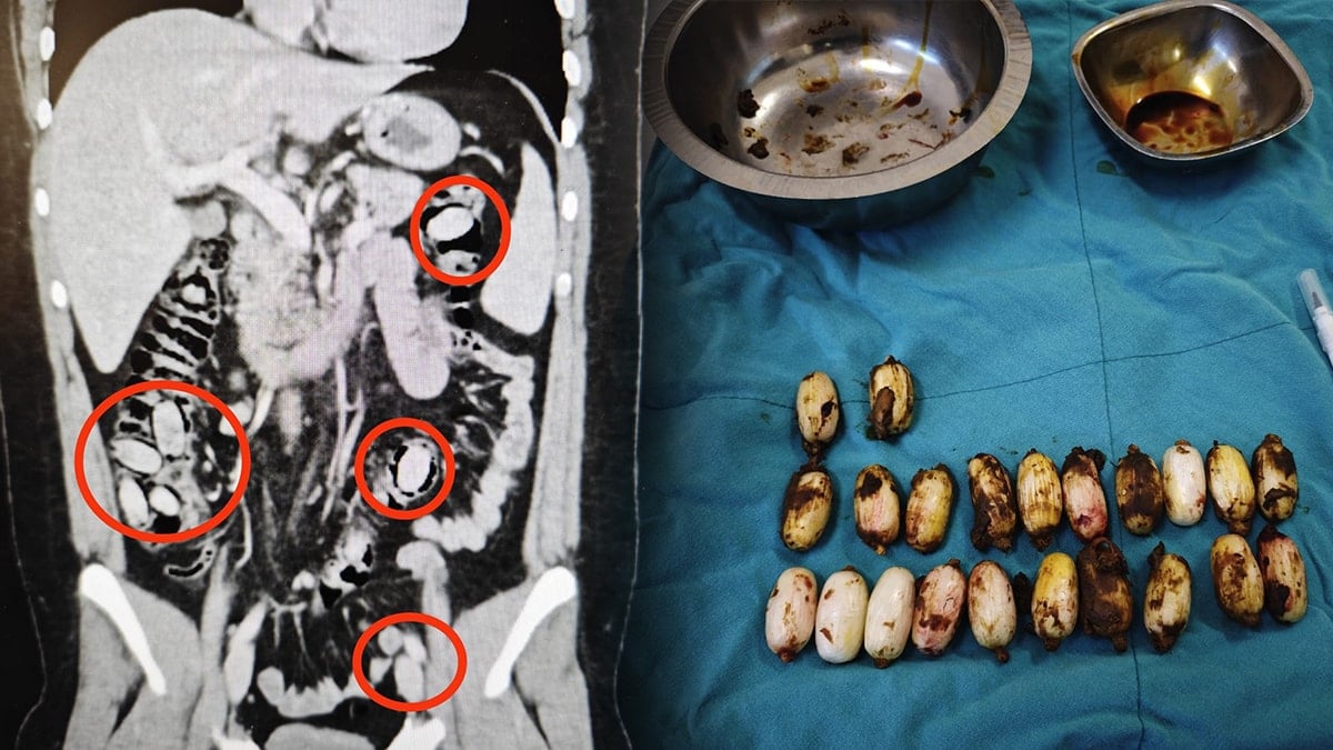 Yurt dışından geldi: Midesinden çıkanlar ağızları açık bıraktı