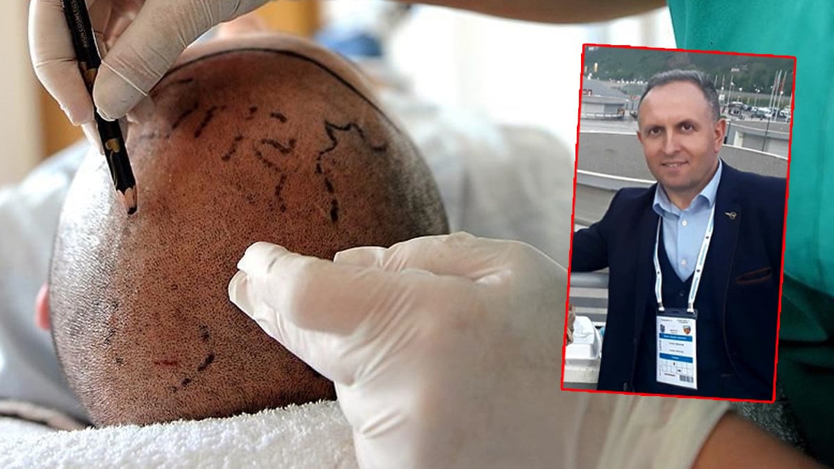 Saç ekimi sonu oldu