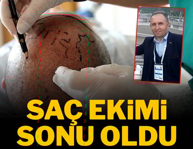 Saç ekimi sonu oldu