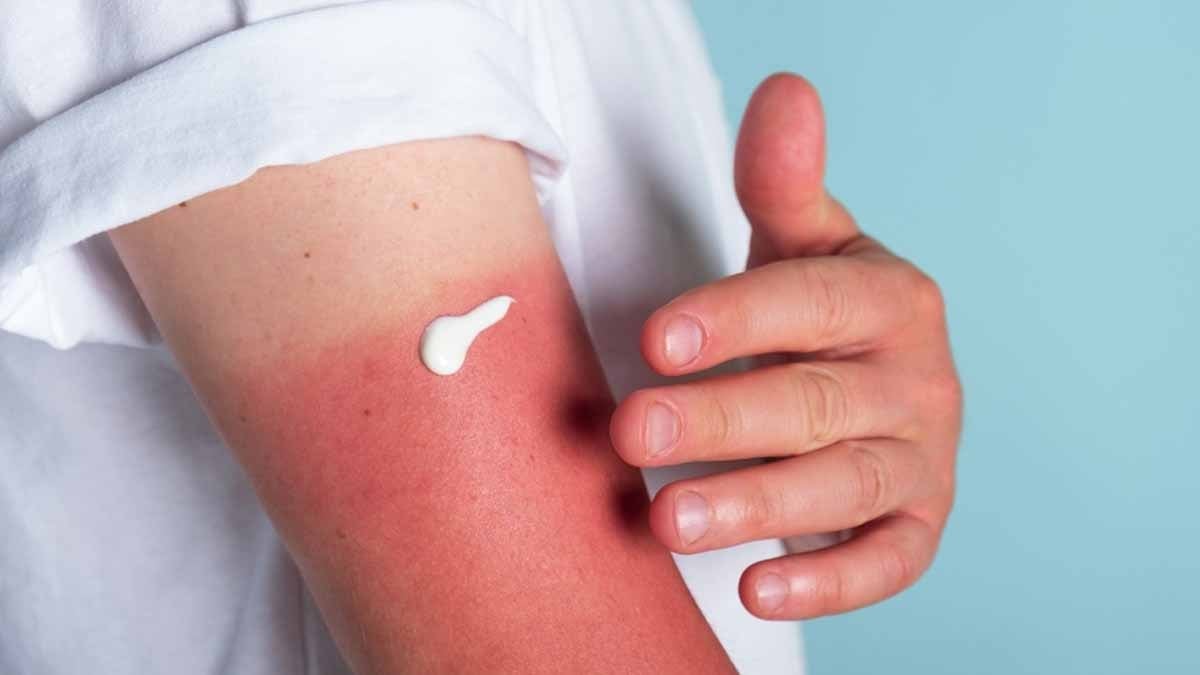 Güneş yanığı tarih oluyor: Asıl suçlu bulundu