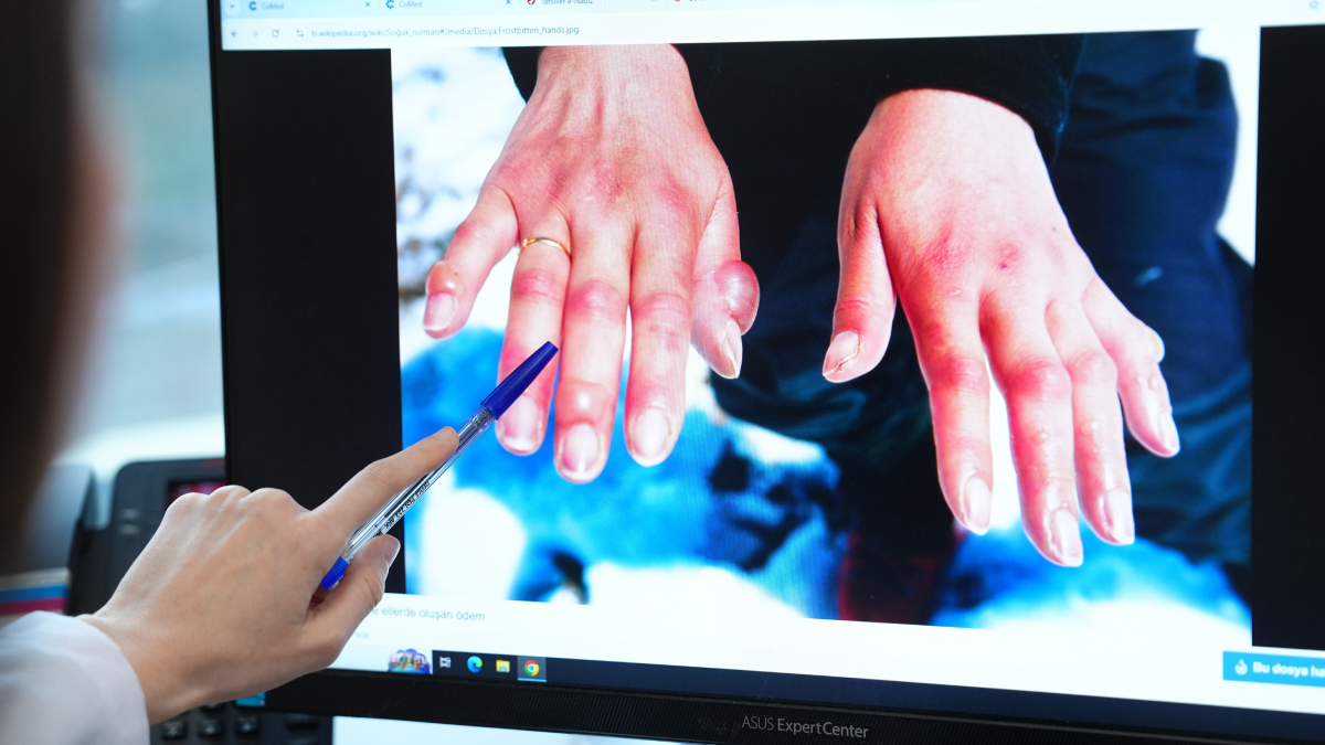 Kış aylarında vakalar patladı... Elinizde bu işaretleri görüyorsanız dikkat