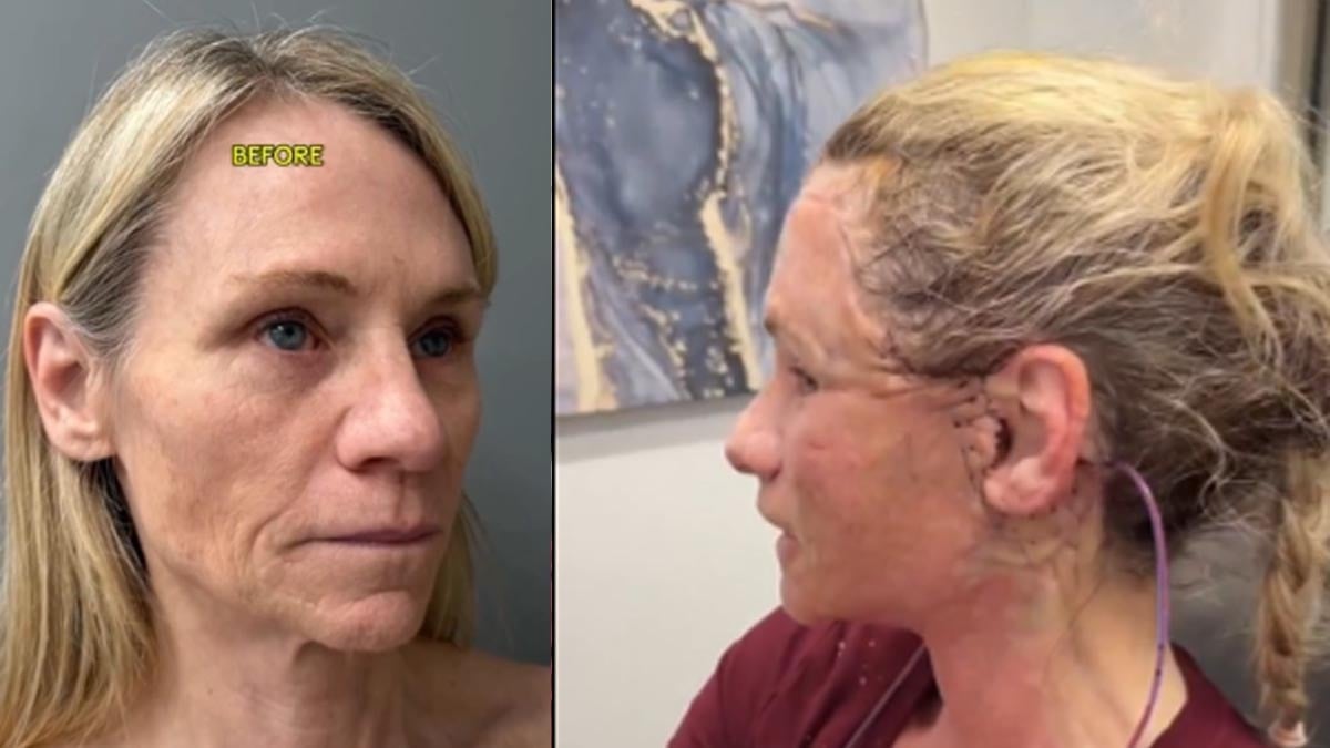 Estetik olan 57 yaşındaki kadını görenler gözlerine inanamadı! Yüzü dikiş içerisinde