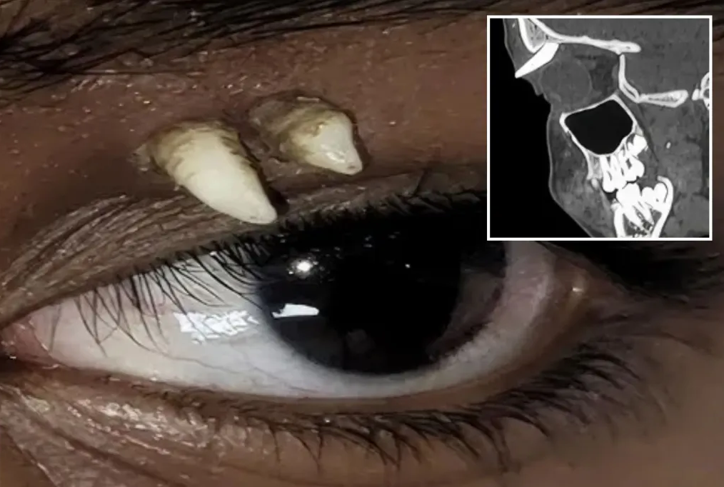 Şişlik şikayetiyle hastaneye gitti, göz çukurunda köpek dişi bulundu