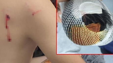 Okul dönüşü köpeklerin saldırdığı çocuğun başına 15 dikiş atıldı
