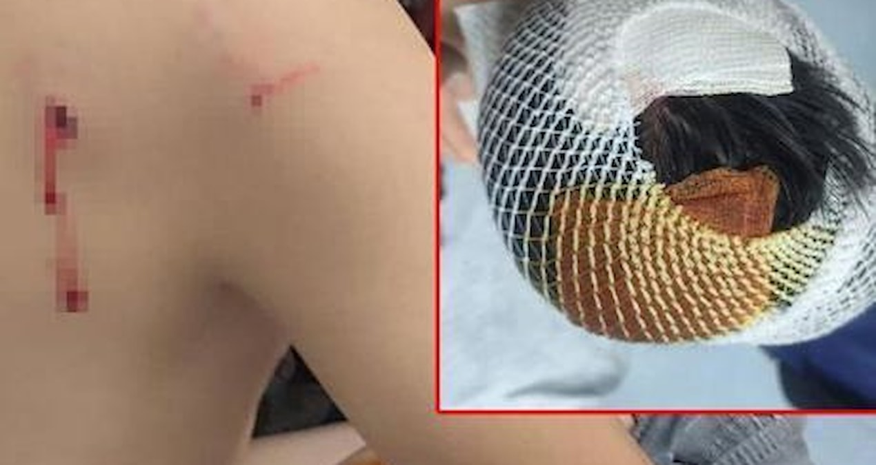 Viranşehir'de okul dönüşü köpeklerin saldırdığı çocuğun başına 15 dikiş atıldı