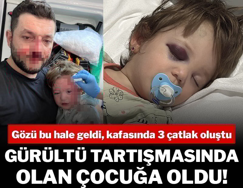 Gürültü tartışmasında olan çocuğa oldu! Gözü bu hale geldi, kafasında 3 çatlak oluştu