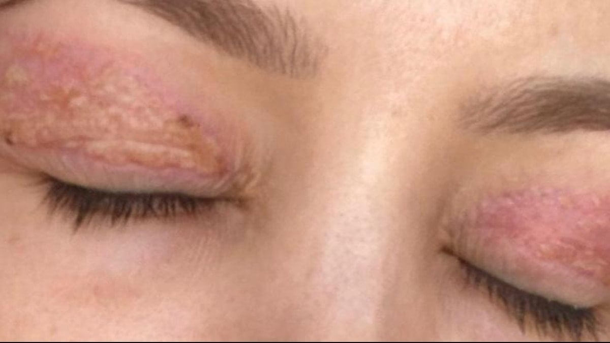 Estetik uğruna gözünü kapatamaz oldu