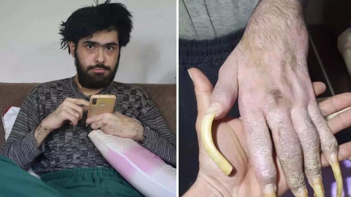 Türkiye'nin konuştuğu depremzede Barış'ın son halini görenler inanamıyor