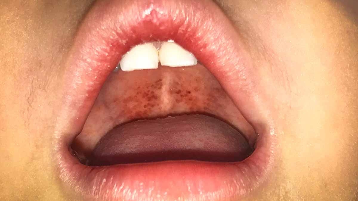 80 yıl sonra korkunç bir hastalık ortaya çıktı!