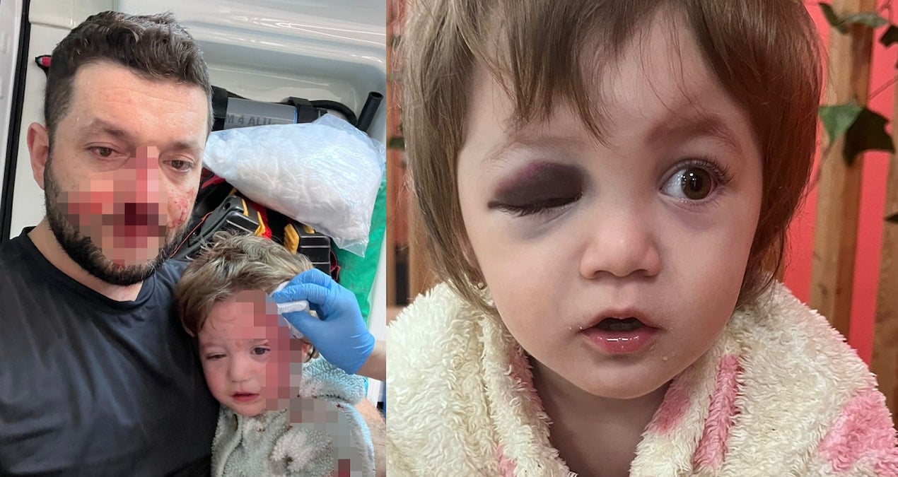Gürültü tartışmasında olan çocuğa oldu! Gözü bu hale geldi, kafasında 3 çatlak oluştu