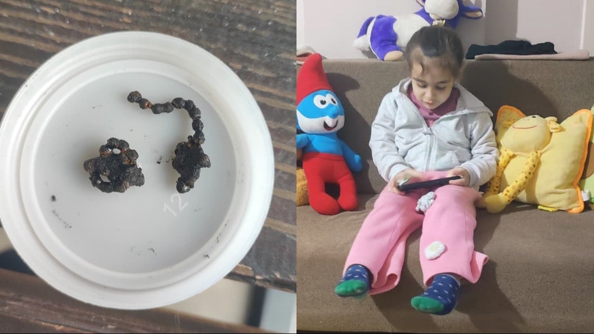 Hastane yetkilileri sessiz! 5 yaşındaki Polen, 2 yıldır burnunda tırnak makası zinciriyle yaşamış