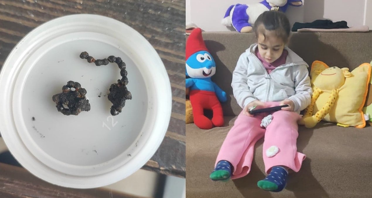 Hastane yetkilileri sessiz! 5 yaşındaki Polen, 2 yıldır burnunda tırnak makası zinciriyle yaşamış