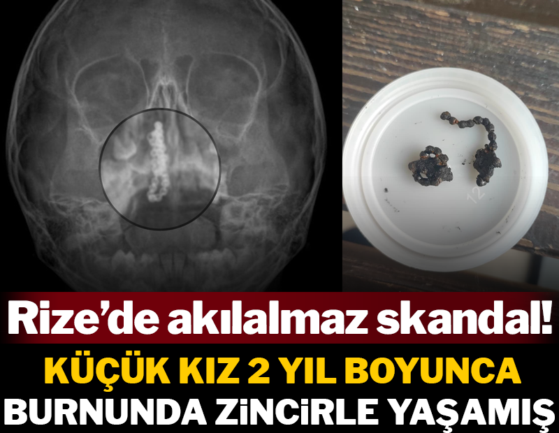 Hastane yetkilileri sessiz! 5 yaşındaki Polen, 2 yıldır burnunda tırnak makası zinciriyle yaşamış