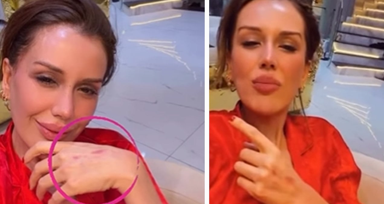 Elleri çizik içinde kaldı! Dilan Polat'ın paylaşımları takipçilerini endişelendirdi