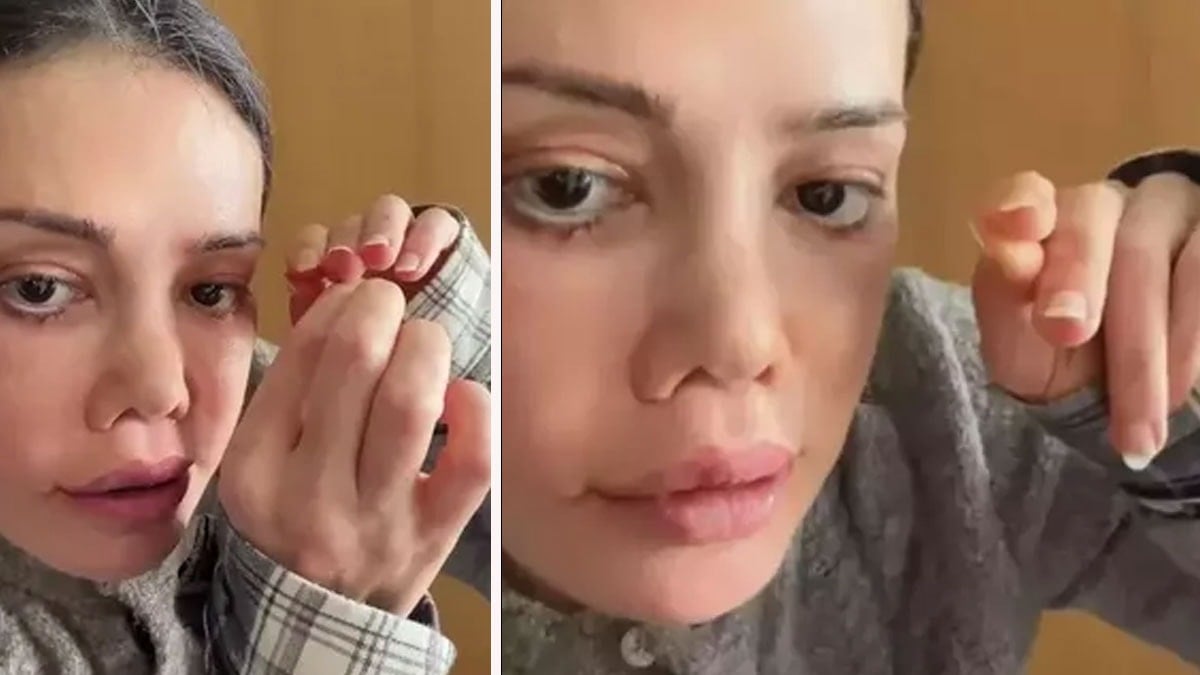 Kaşında saç çıktı! Yüz nakli olan Didem Ceran son haliyle şoke etti