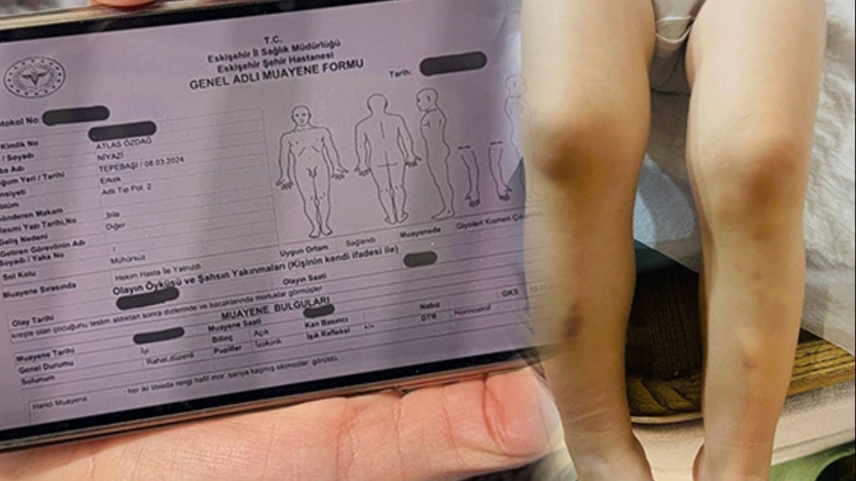 2 yaşındaki Atlas'ın kreş kabusu: Vücudundaki morlukları gören annesi savcılığa koştu