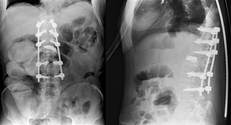 Ağrı şikayetiyle hastaneye geldi, 8,5 kilogramlık tümörlü böbrek çıktı