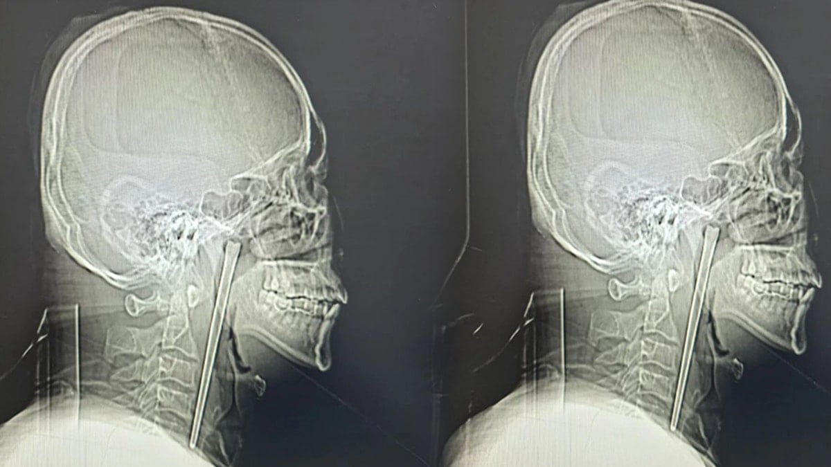 8 yıl boyunca boğazındakiyle yaşadı