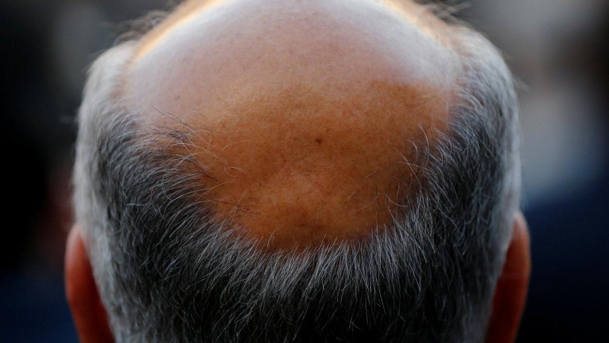 Dünya kellik haritası açıklandı: Türkiye’nin sırası dikkat çekti