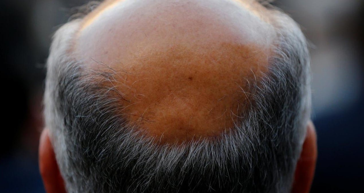 Dünya kellik haritası açıklandı: Türkiye’nin sırası dikkat çekti