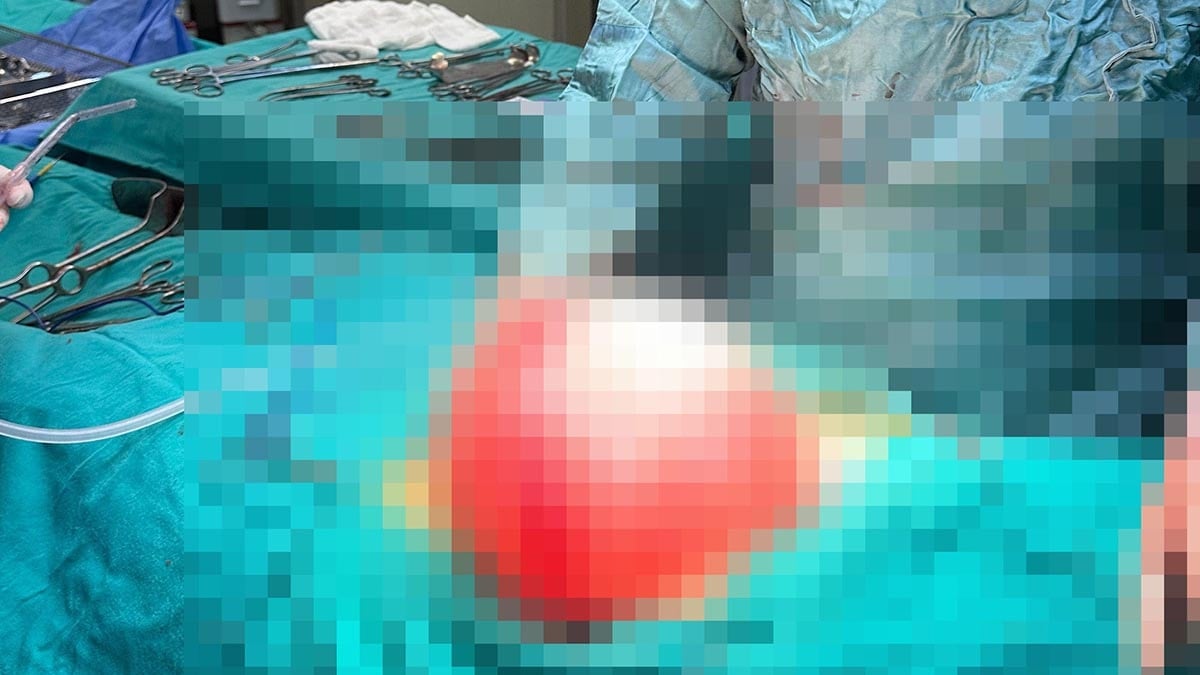 Kilolalarından kurtulmak için gitti, karnından 3,5 kilo kist çıktı