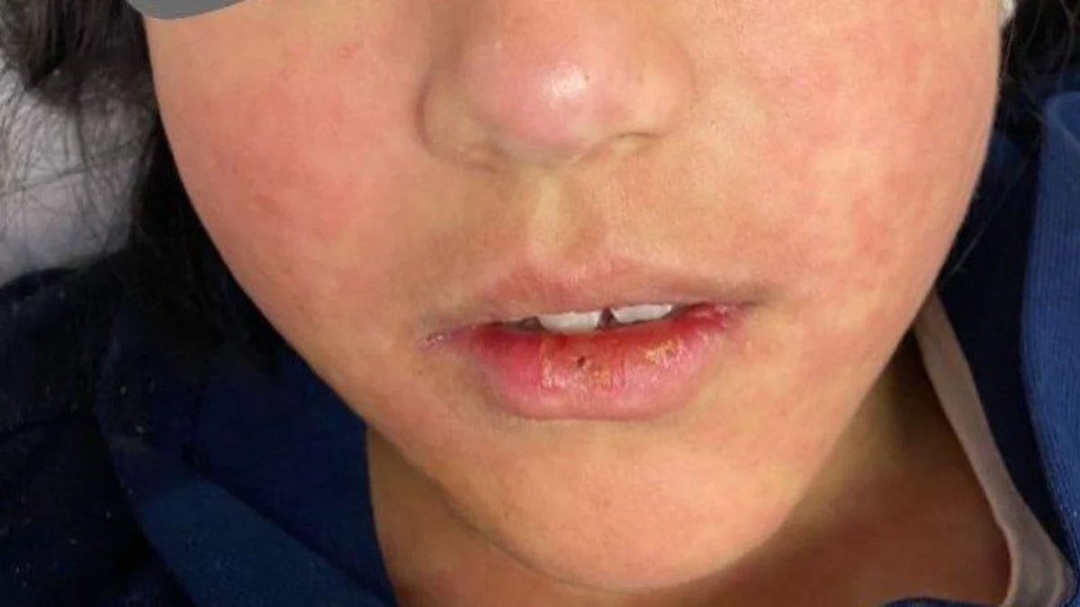 Hastalık yayılıyor, 6 haftada 227 çocuk öldü