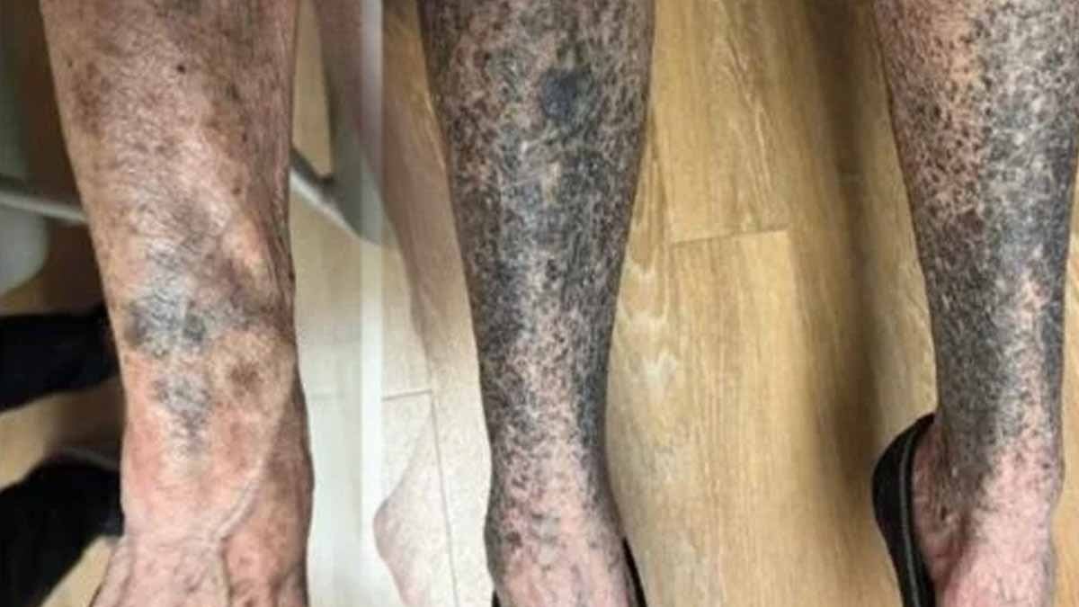 Antibiyotik kullandıktan sadece 14 günde tüm vücudu maviye döndü!