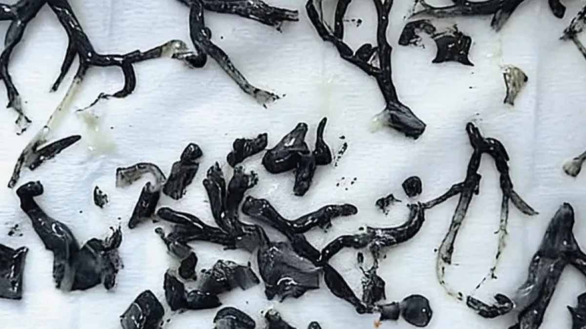 87 yaşındaki adamın akciğerinden 'ağaç' çıkardılar