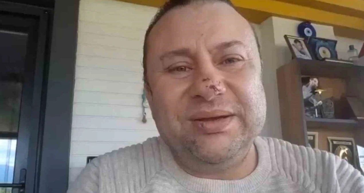 Pitbull saldırısında et yiyen bakteri bulaştı: İşte Onur Akay'ın son durumu