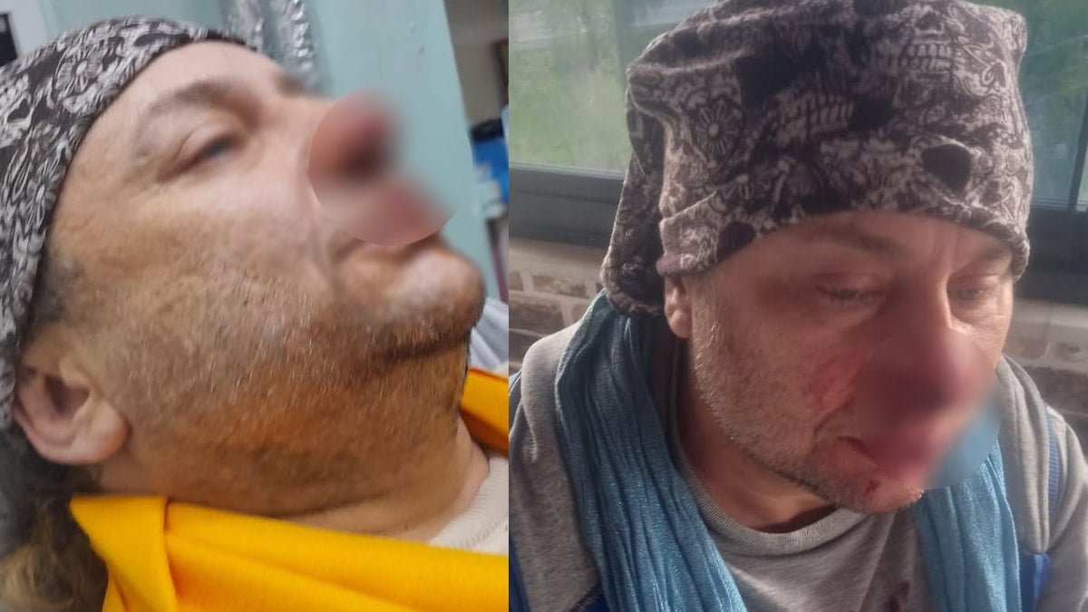 Ünlü isim köpek saldırısında az kalsın canından oluyordu: Burnu koptu