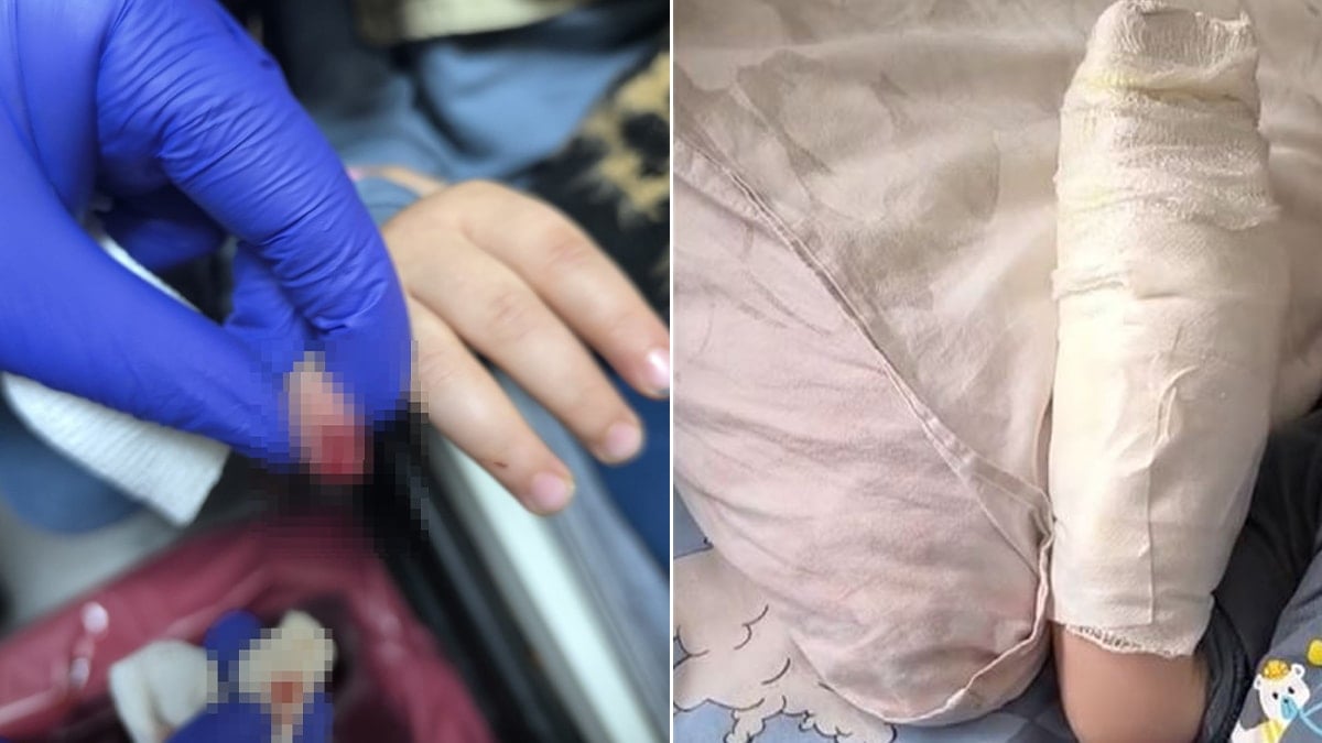 3 yaşındaki çocuğun yürüyen merdivende parmağı koptu