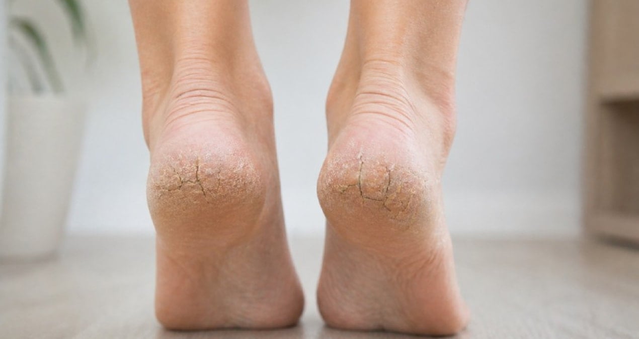 Topuk çatlaklarından kurtulmanın en basit yolu belli oldu: Sadece 15 dakika bekletmek yetiyormuş