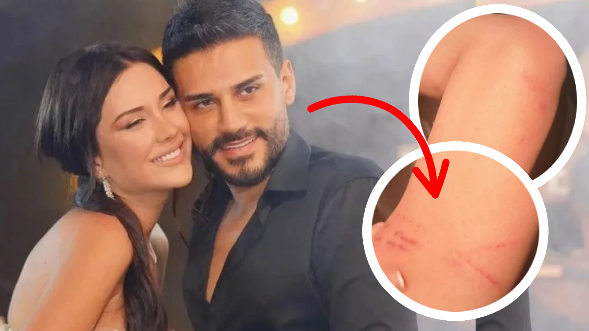 Dilan Polat'tan gece yarısı bomba paylaşım: Darp izlerini paylaşıp sildi