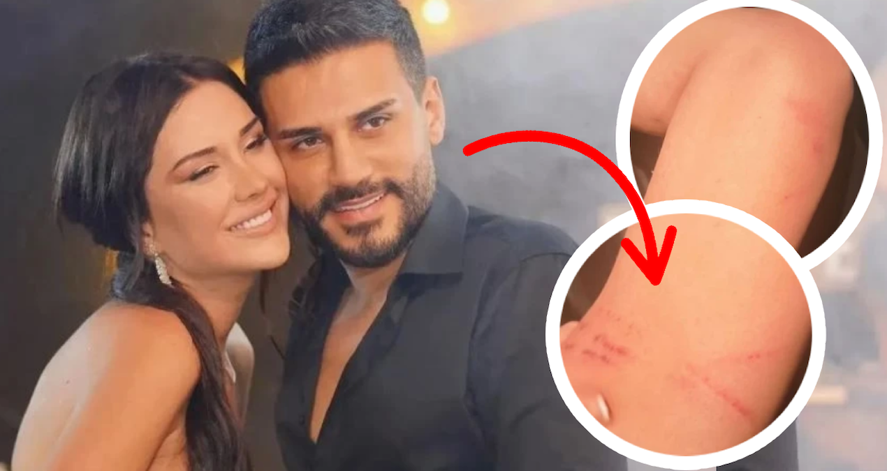 Dilan Polat darp izlerini paylaşıp sildi: Boşanacaksın oğlum benden