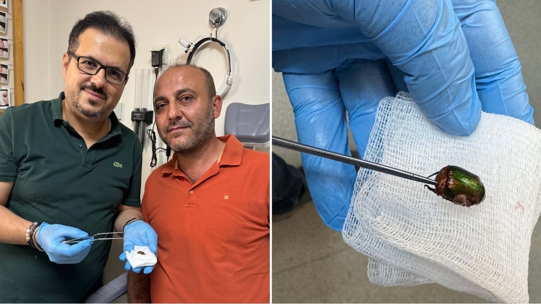 Ağrı ve işitme kaybıyla hastaneye gitti, kulağından böcek çıktı