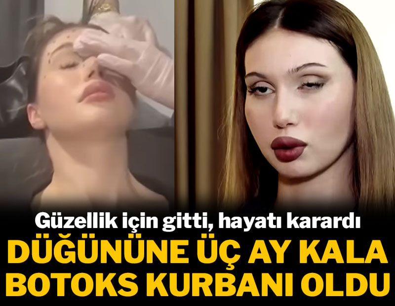 Düğününe üç ay kala botoks kurbanı oldu