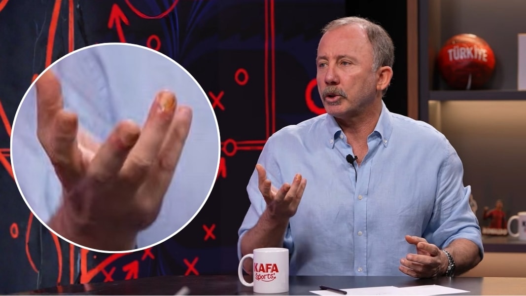 Sergen Yalçın'ın parmaklarına ne oldu?