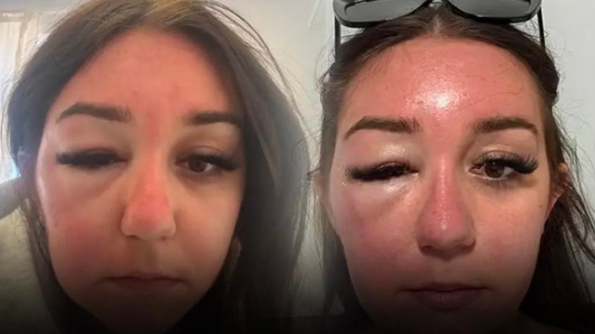 Tatilde kabusu yaşadı: Yüzü tanınmaz hale geldi