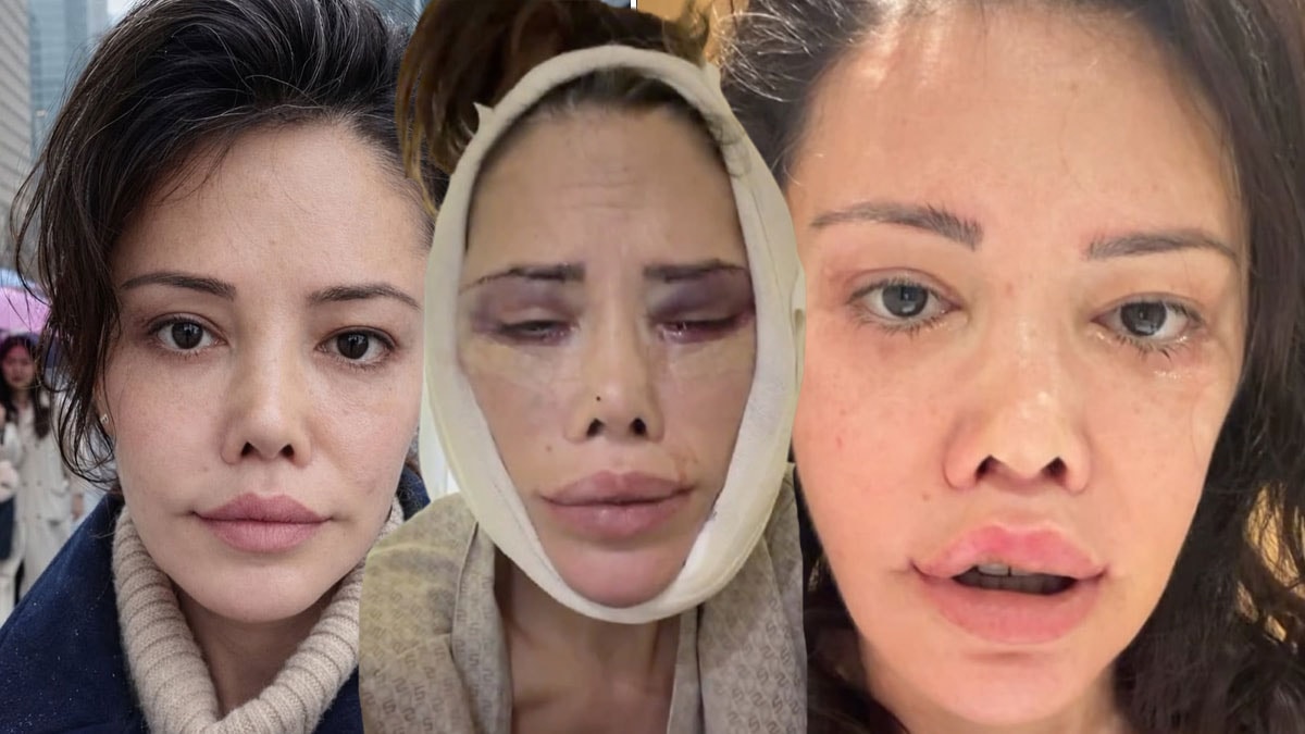 Yüz nakli sonrası bir kez daha bıçak altına yattı: Son haline kimse dayanamadı