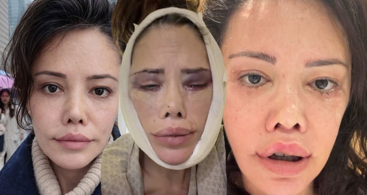Yüz nakli sonrası bir kez daha bıçak altına yattı: Son haline kimse dayanamadı