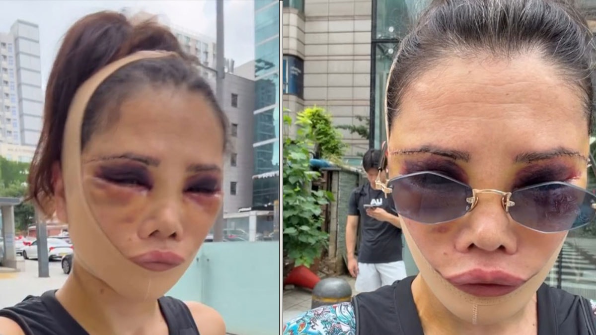 Didem Ceran yeniden ameliyat oldu: Son halini paylaşıp eleştirilere yanıt verdi
