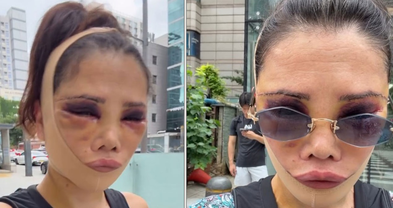 Didem Ceran yeniden ameliyat oldu: Son halini paylaşıp eleştirilere yanıt verdi
