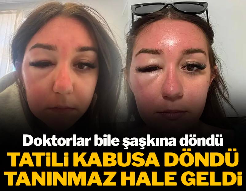 Tatilde kabusu yaşadı: Yüzü tanınmaz hale geldi