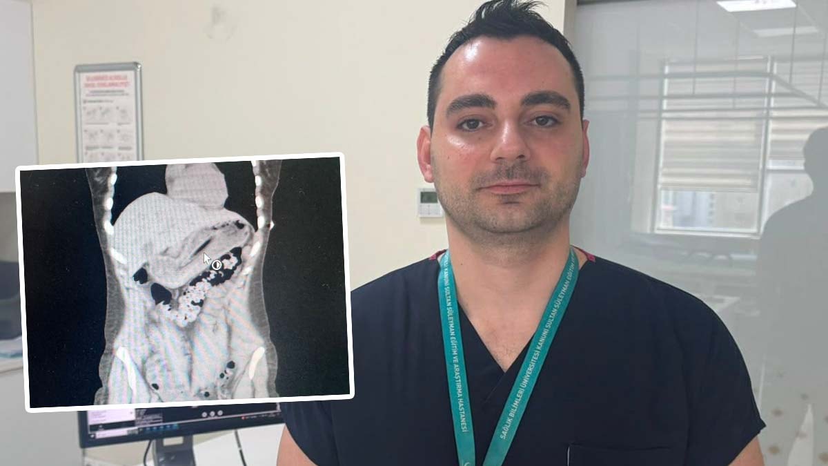 Zayıflamak isterken 13 santimetrelik diş fırçası yuttu: Doktorlar bile şaştı kaldı