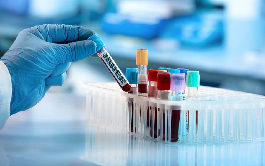 Alzheimer'a erken teşhiste devrim: Kan testiyle fark ediliyor